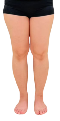かわのさん ビフォー（脚部・正面）